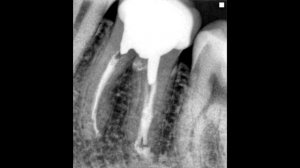 Что такое бифуркация. И что делают в перфорацией в области бифуркации.