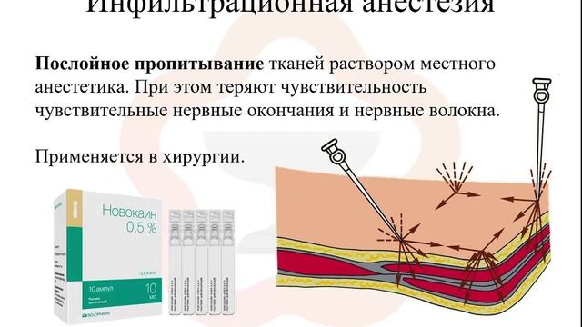 3.3.  Виды анестезии