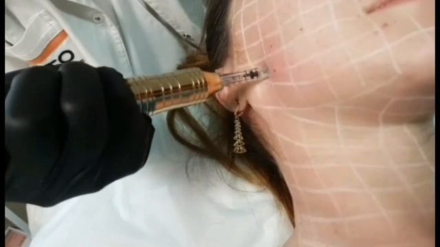 Hyaluronic pen video course. Обучающий видеокурс по гиалуроновой ручке