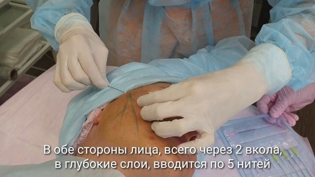 Aptos Excellence Visage: тредлифтинг лица в Центре инновационной косметологии ALTEOS Beauty, г.Ижев