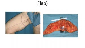 Reconstructive Surgery Options for Women with Breast Cancer