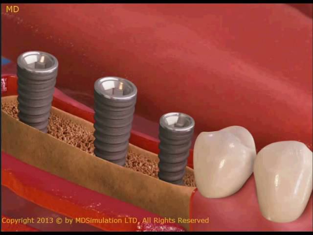 Installation of the implant, part 2 смотреть онлайн