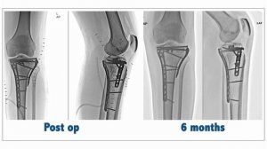 Posteromedial tibial plateau fixation