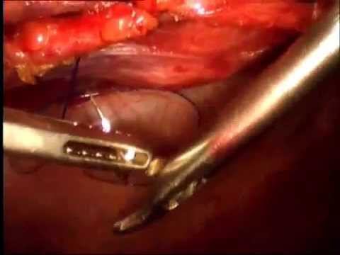 paraumbilical hernia смотреть онлайн