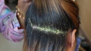 Removal Dandruff Flakes With Lice Comb Psoriasis Flakes Scalp # 1550