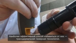 Лечение сосудистых звездочек лазером