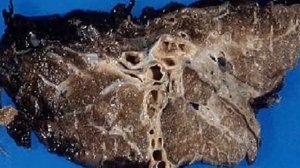 Последствия вредных привычек