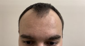 2600 графтов для Ивана