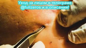 Новое! Выдавливание прыщей # Удаление черных точек 2021 # Прыщи выдавливание # Черная маска