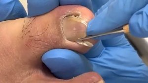 The hook in the patient's toenail has been there for too long【Xue Yidao】