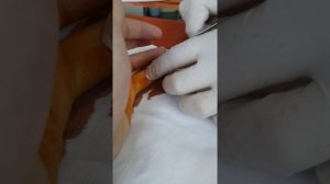 Как вытащить крючок из пальца