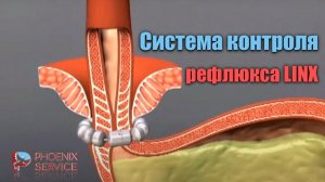 Система контроля рефлюкса LINX