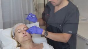 Linerase zabieg - Linerase treatment