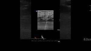 Разбираем Стил-синдром по данным УЗИ. Автор Сниткин В.М. Steal-syndrome.