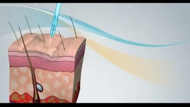 JetPeel Laser Soprano Ice Beauty Village Nidderau смотреть онлайн