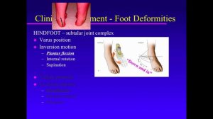 Biomechanics Of The Pediatric Foot. Principle 02. Subtalar Joint Positions & Motions