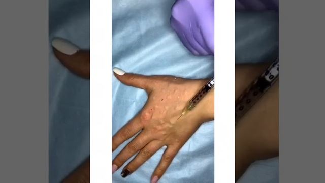 Биоревитализация рук гиалуроновой кислотой смотреть онлайн