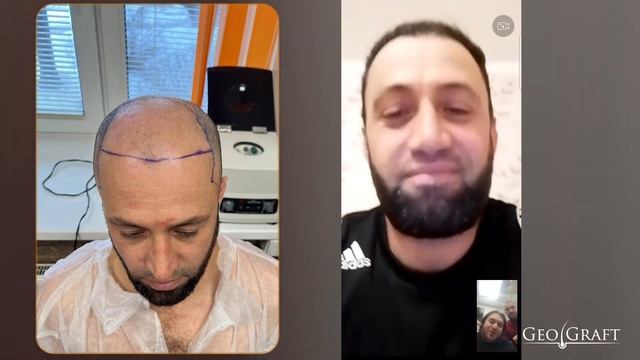 Пересадка волос в Москве, цена 90-120 тыс.₽ Отзыв пациента GeoGraft смотреть онлайн