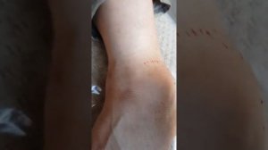 Опухли стопы делаем хиджаму.