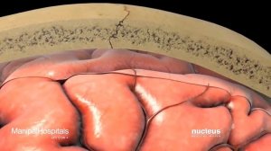 Восстановление после Геморрагического инсульта