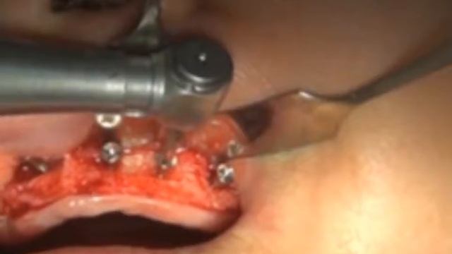 Применение костного клея при латеральной аугментации смотреть онлайн