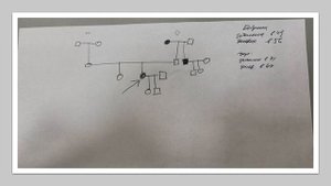 Спиноцеребеллярная атаксия