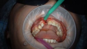 Удаление титановой мембраны IGen и установка формирователя десны на имплантат Эниридж