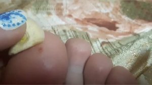 НАТОПТЫШИ, БОРОДАВКИ НА НОГАХ. ?% ИЗБАВЛЕНИЕ. САМЫЙ БЫСТРЫЙ И ДОСТУПНЫЙ СПОСОБ.