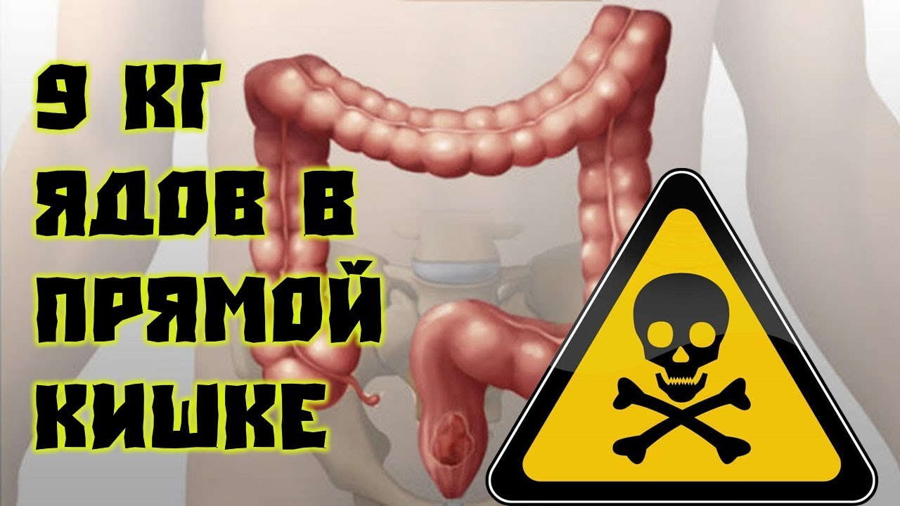 У вас около 9 кг ядов в прямой кишке — вот что вы можете сделать! смотреть онлайн