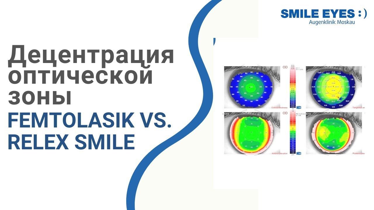 Децентрация оптической зоны при лазерной коррекции зрения: FemtoLASIK Vs. ReLEx SMILE