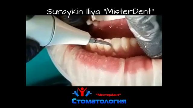 удаление зубного камня смотреть онлайн