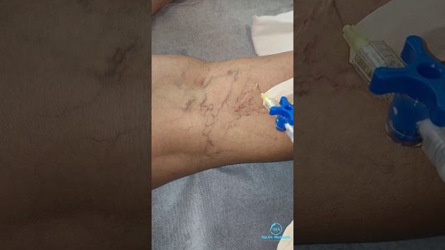 Skleroterapiya - Sclerotherapy - Склеротерапия