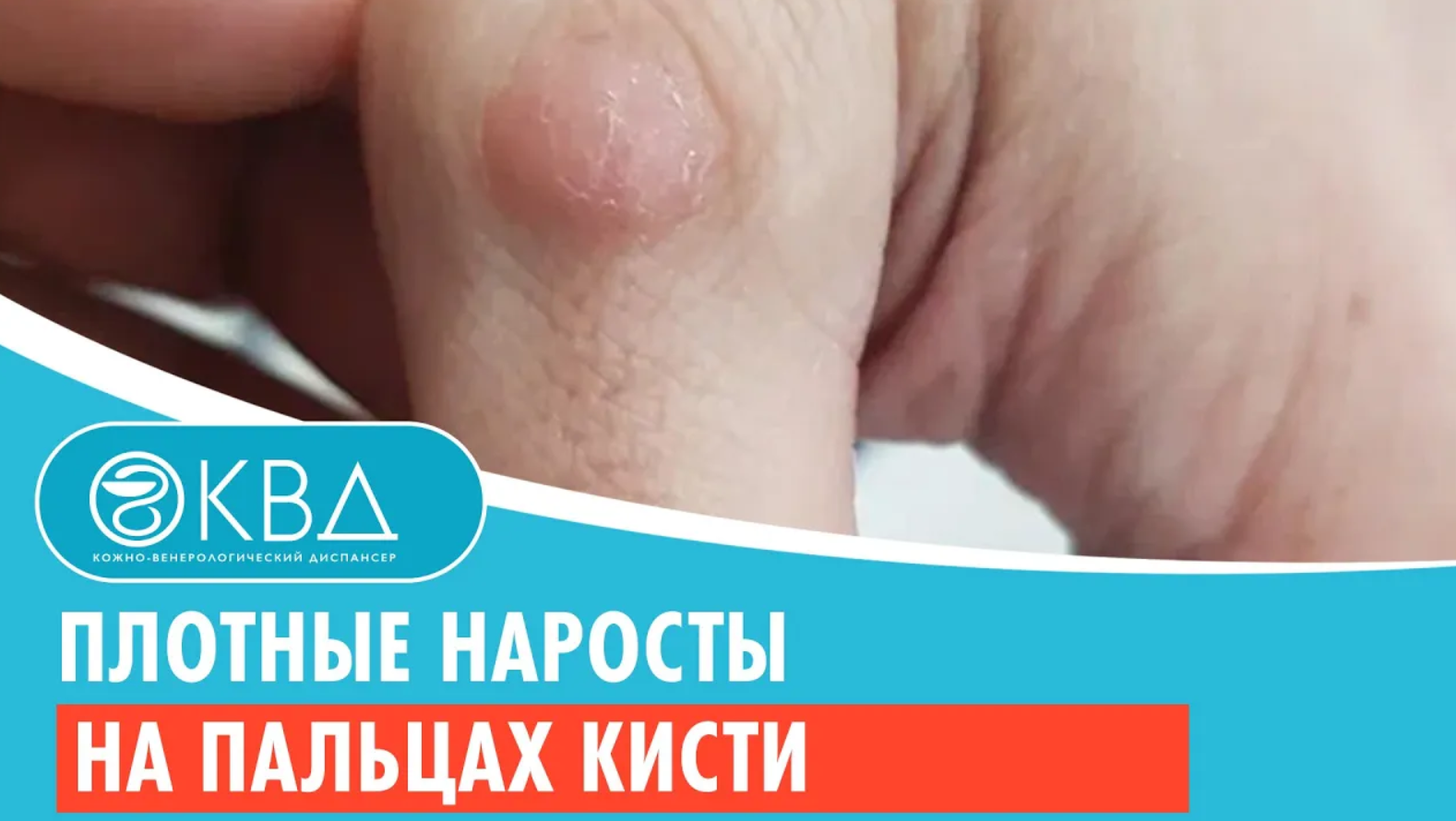 ? Плотные наросты на пальцах кисти. Клинический случай №741