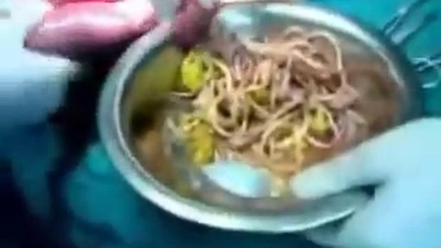 Удаление глистов хирургическим путем – смотреть онлайн видео от Быстро ...