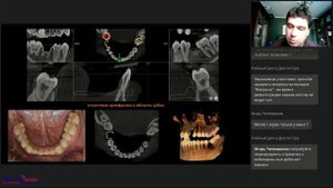 Планирование дентальной имплантации по данным КЛКТ в сложных клинических условиях