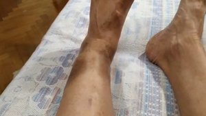 Аппарат Иллизарова. Открытый перелом ноги. 7 лет спустя
