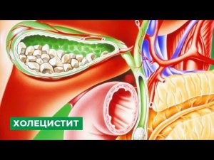 Холецистит