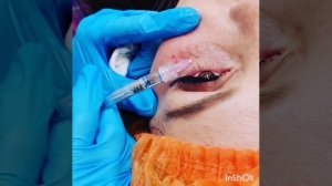 мезотерапия вокруг глаз