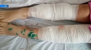В Уфе на 13-летнюю девочку напали бродячие собаки: подробности трагедии