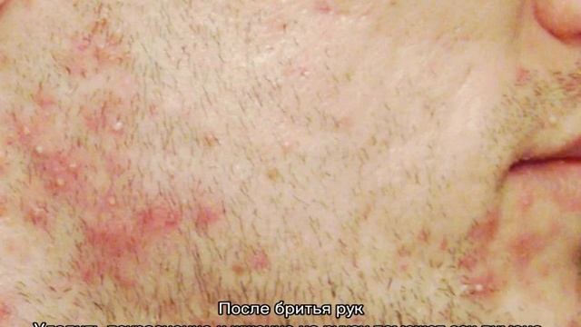 Раздражение после бритья