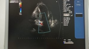 Вторичный дефект межпредсердной перегородки у пациента с передним инфарктом миокарда