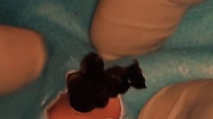 Удаление большой черной точки Удаление гнойника