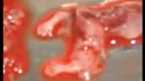 Аборт и выкидыши.