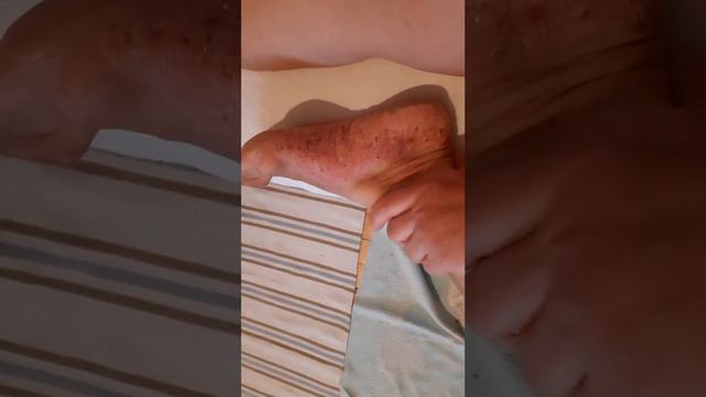 ХРОНИЧЕСКАЯ СУХАЯ ЭКЗЕМА СТОП  БЕЗ ВОСПАЛЕНИЯ