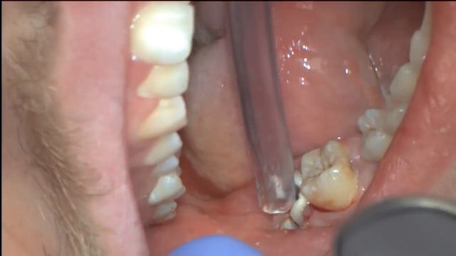 Удаление зуба мудрости