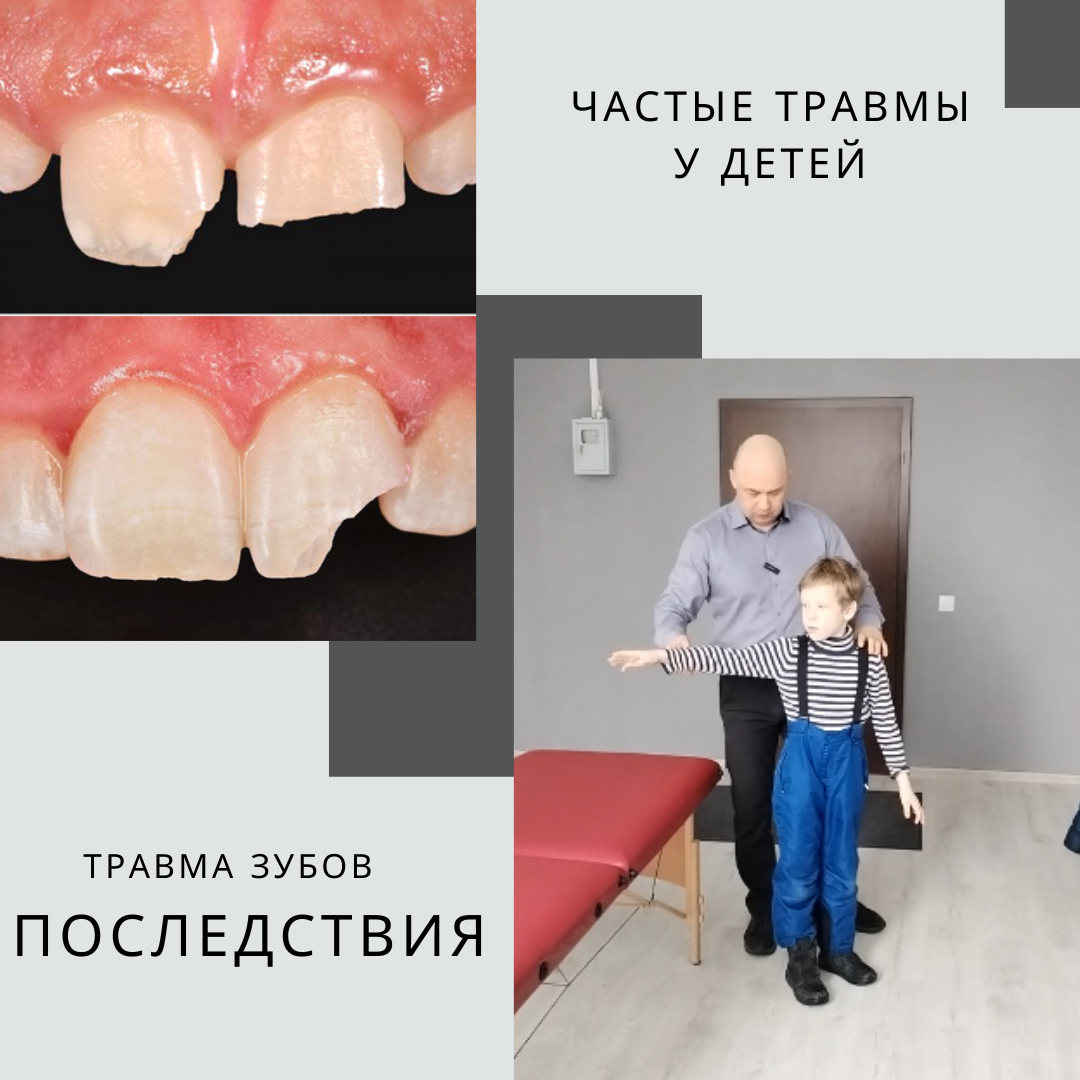 Частые травмы у детей. Перелом зуба.
