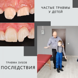 Частые травмы у детей. Перелом зуба.