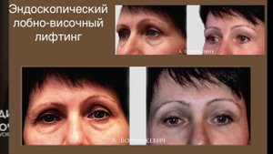Эндоскопический лифтинг. Вопрос ответ