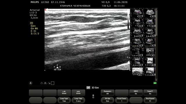 2020061115545771 УЗИ артерий ног смотреть онлайн