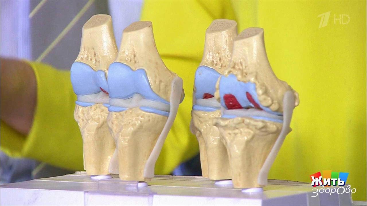Остеоартроз: боль в коленных суставах. Жить здорово! Фрагмент выпуска ...